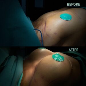 breast augmentation