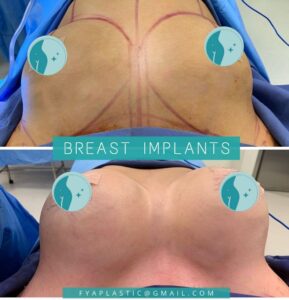 breast implants