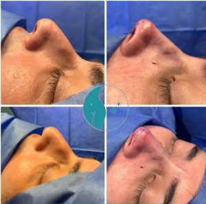 Rhinoplasty-bef-af