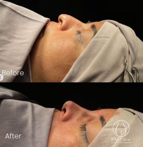 Rhinoplasty-before-after