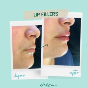 fillers-ba