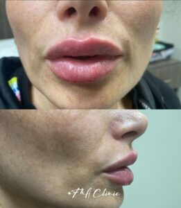 lip-filler-ba