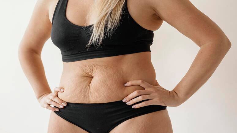 Why Does Loose Skin Happen After Weight Loss?