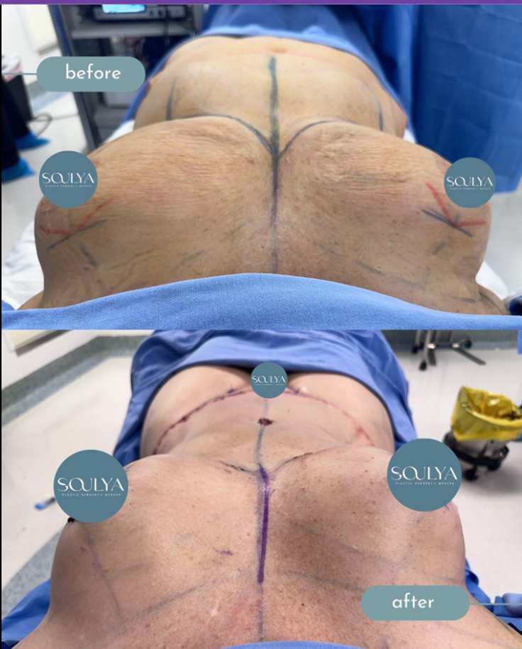 Surgical Procedures to Lift Sagging Breasts