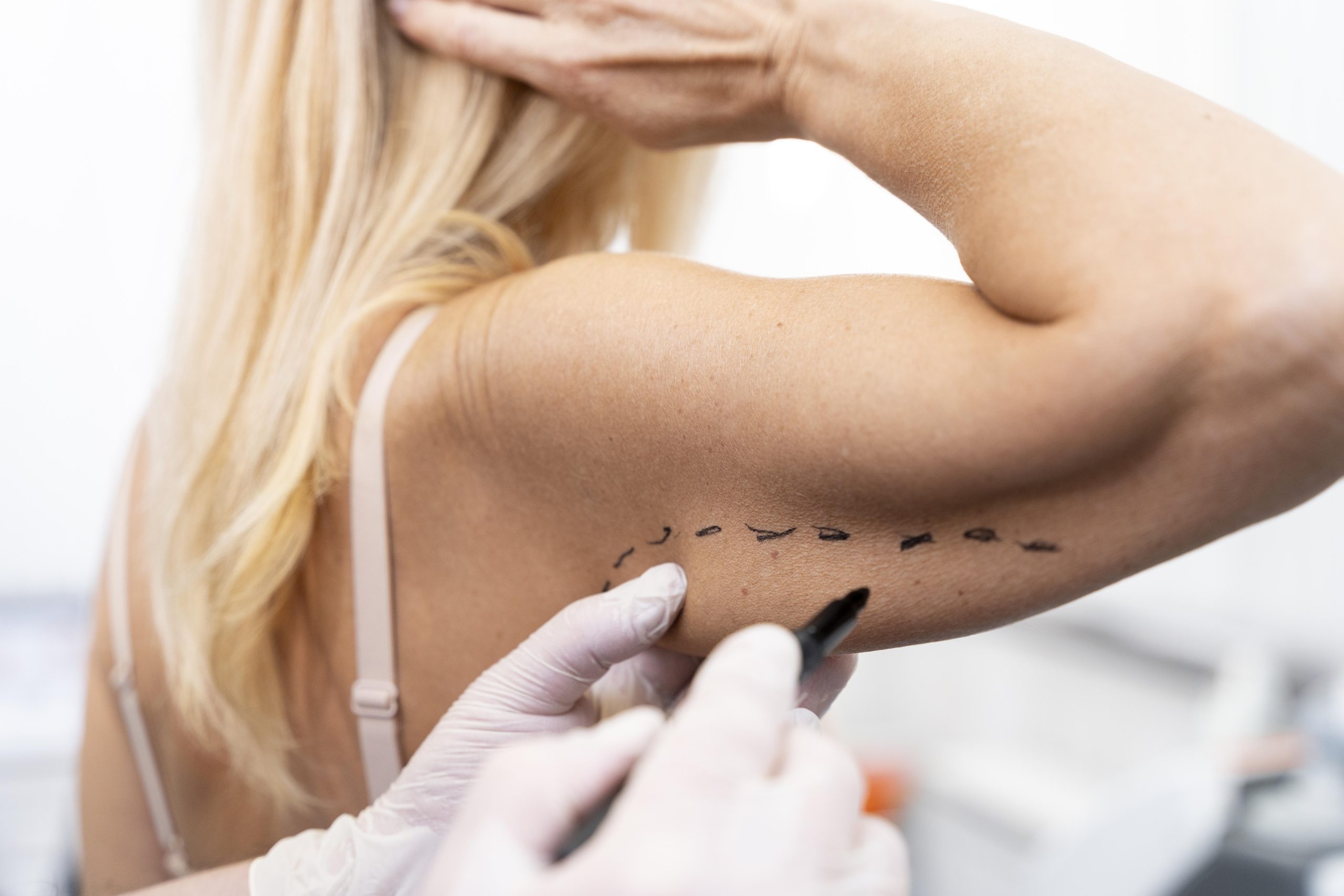 brachioplasty in Tijuana