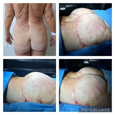 Brazilian Butt Lift Before and After
