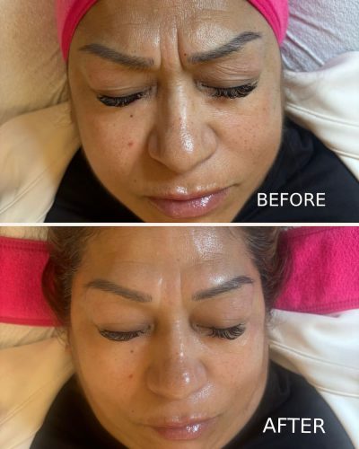 Hydrafacial