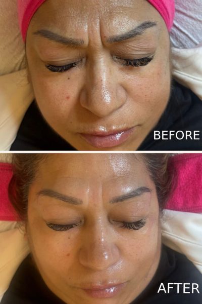 Hydrafacial