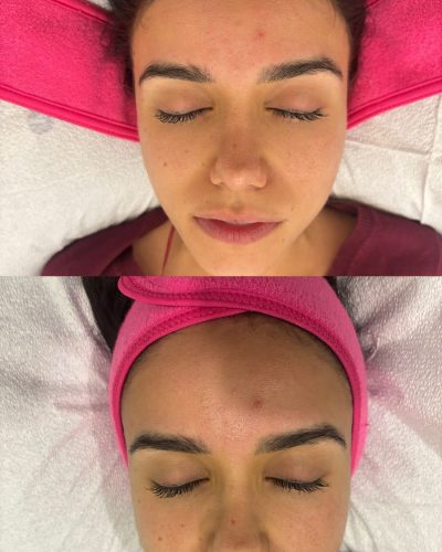Hydrafacial_before&afer_spa