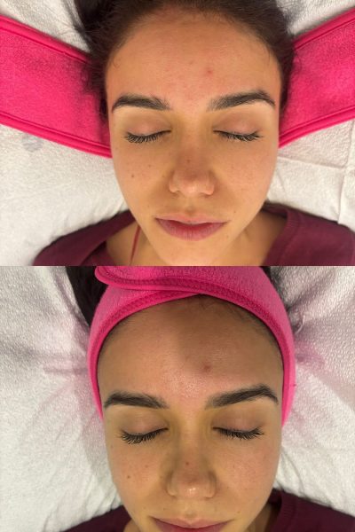 Hydrafacial_before&afer_spa