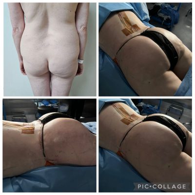 Liposuccion-360+ BBL