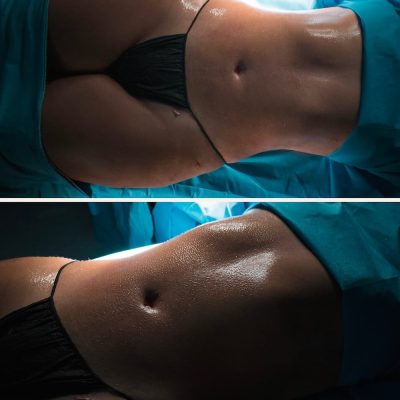 Liposuccion-360-mexico