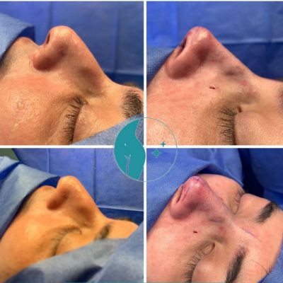 rinoplastia antes y después