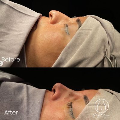 Rhinoplasty Before and After