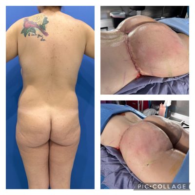 procedure brazilian butt lift