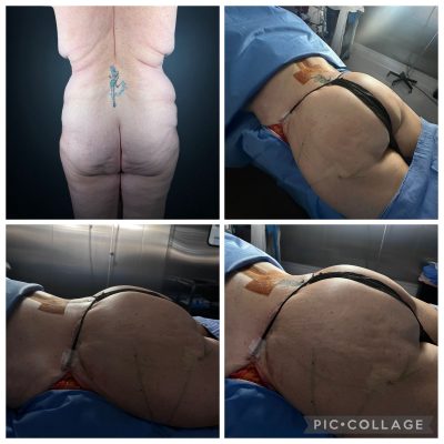 abdominoplastia-tijuana