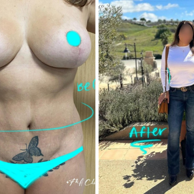 After of a lipo 360 in Mexico
