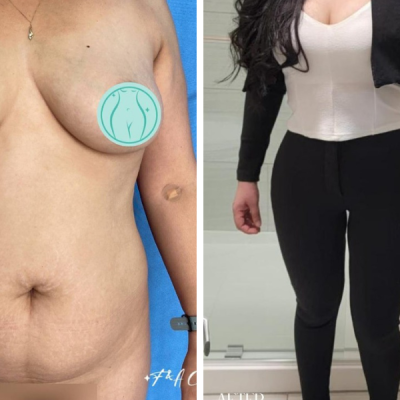 Before and after of a lipo 360 in Tijuana