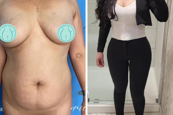 before-after-lipo360