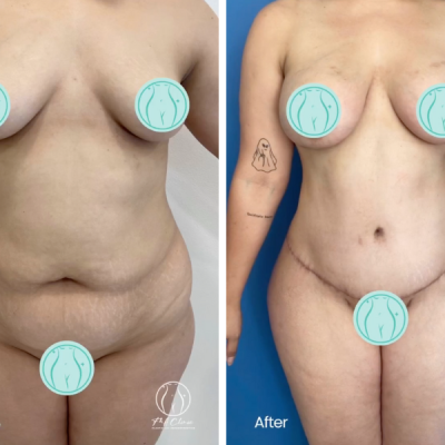 Before and after of mommy makeover