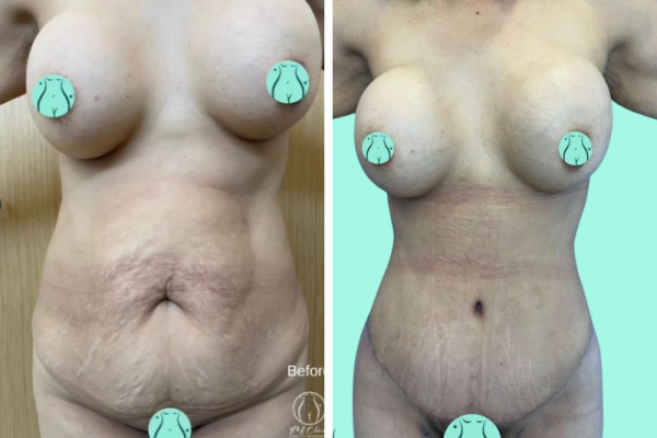 before-after-tummytuck