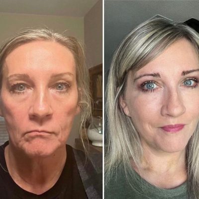before_and_after_bichectomy