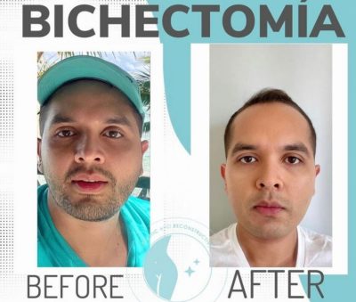 bichectomy-before-after