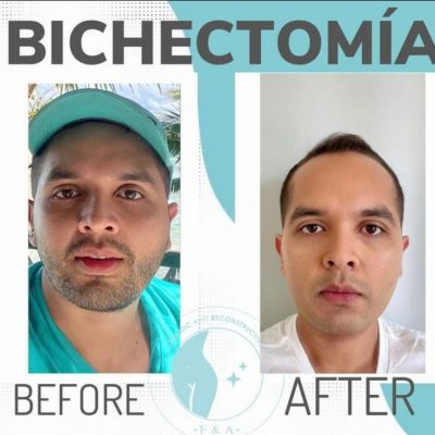 Bichectomy Before and After ​