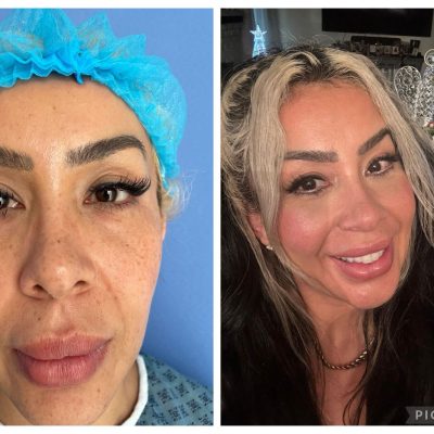blefaroplastia_B&A