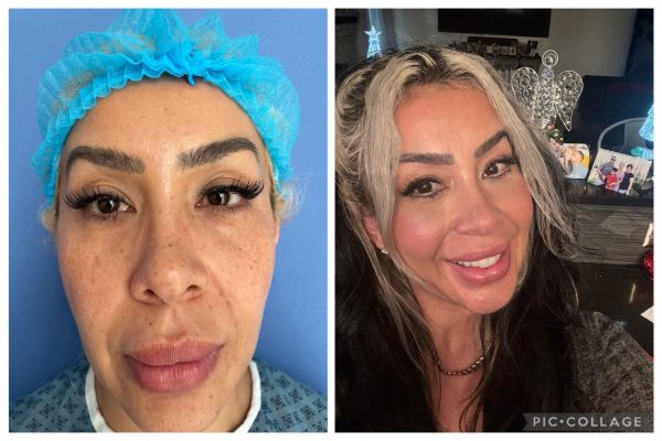 blefaroplastia_B&A