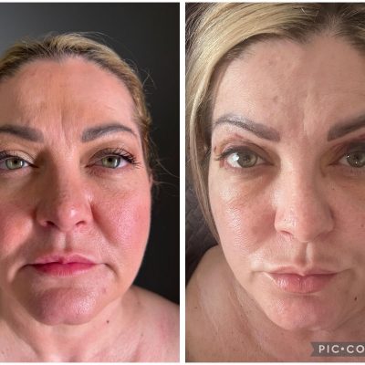 blepharoplasty in tijuana before and after