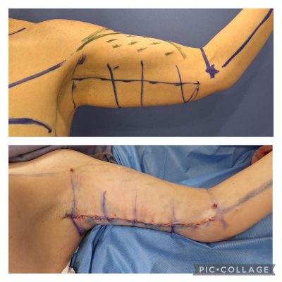 Brachioplasty Before and After