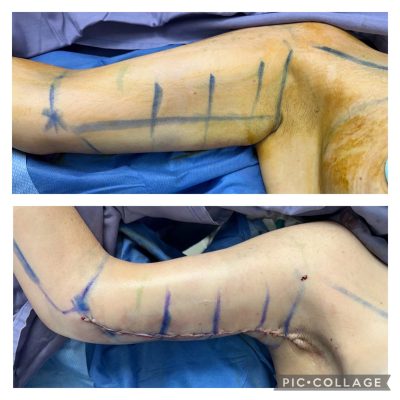 Braquioplastia antes y después