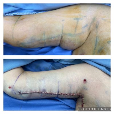 Brachioplasty results
