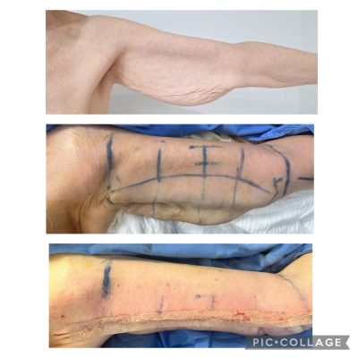 resultados de la braquioplastia