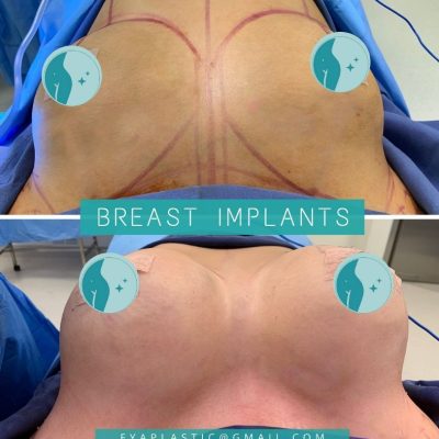 Before and after of breast implants