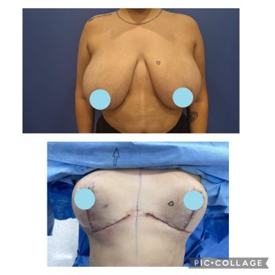 Breast Reduction Before and After ​