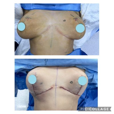 Antes y después de una reducción de busto