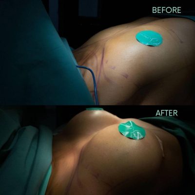 Breast implants in Tijuana, Before and after