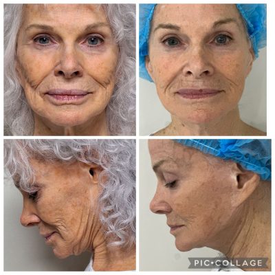 face-lift-tijuana