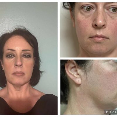face_lift_surgery