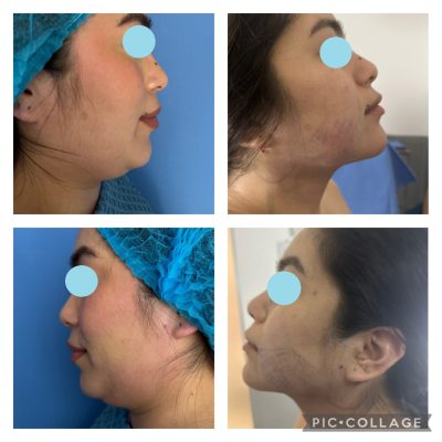 Facial Liposuction Before and After