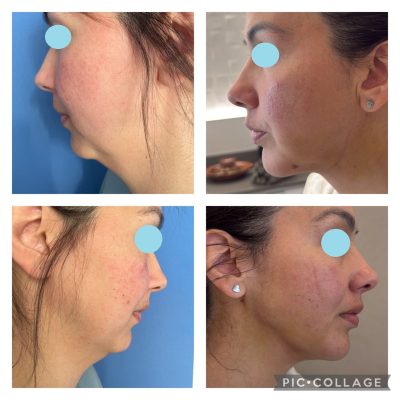 Liposucción facial antes y después