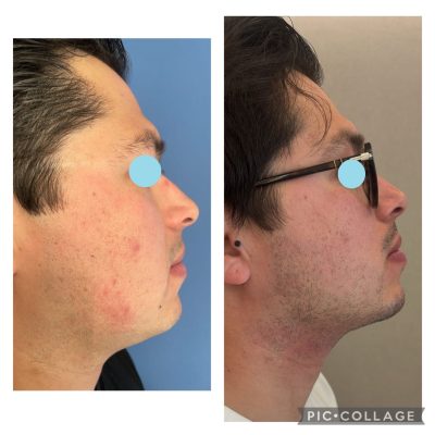 Facial Liposuction results