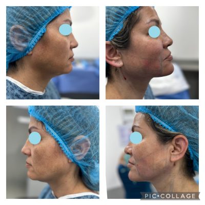resultados de la liposucción facial