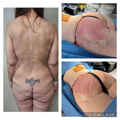 levantamiento-glúteos-tijuana