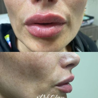 lip-filler-ba
