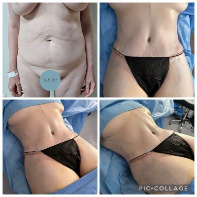 lipo-360-mexico