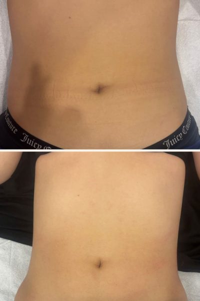 radiofrecuencia-accent-prime