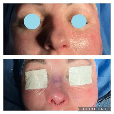 resultados de la rinoplastia